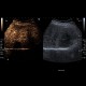 Liver metastasis, CEUS: US - Ultrasound